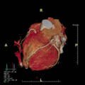 What to Expect During a Coronary CT Angiogram