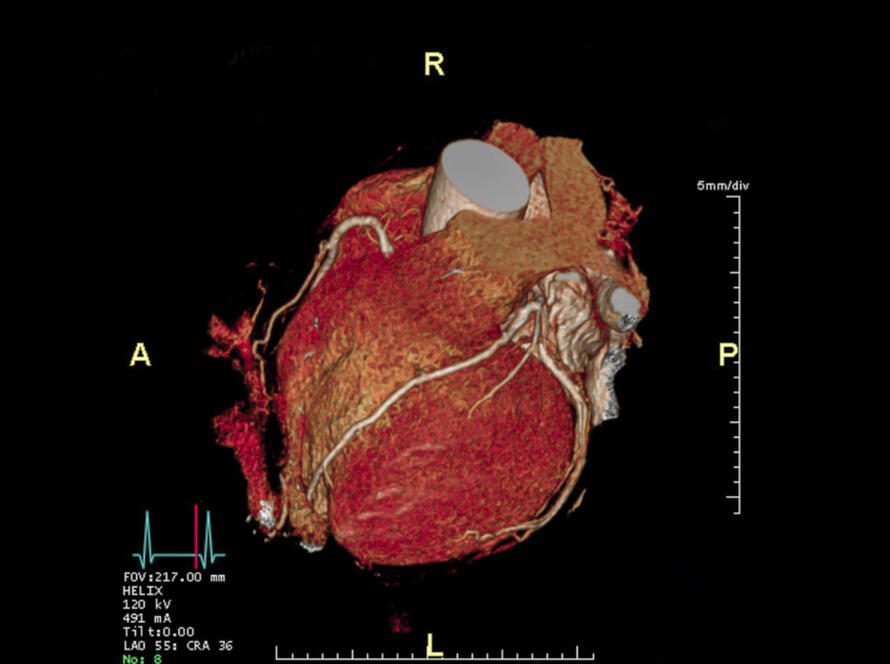3D medical scan of a human heart from a coronary CT angiogram, with labeled anatomical directions (anterior, posterior, right, left); includes a color-coded heartbeat graph and measurement scale on a black background.