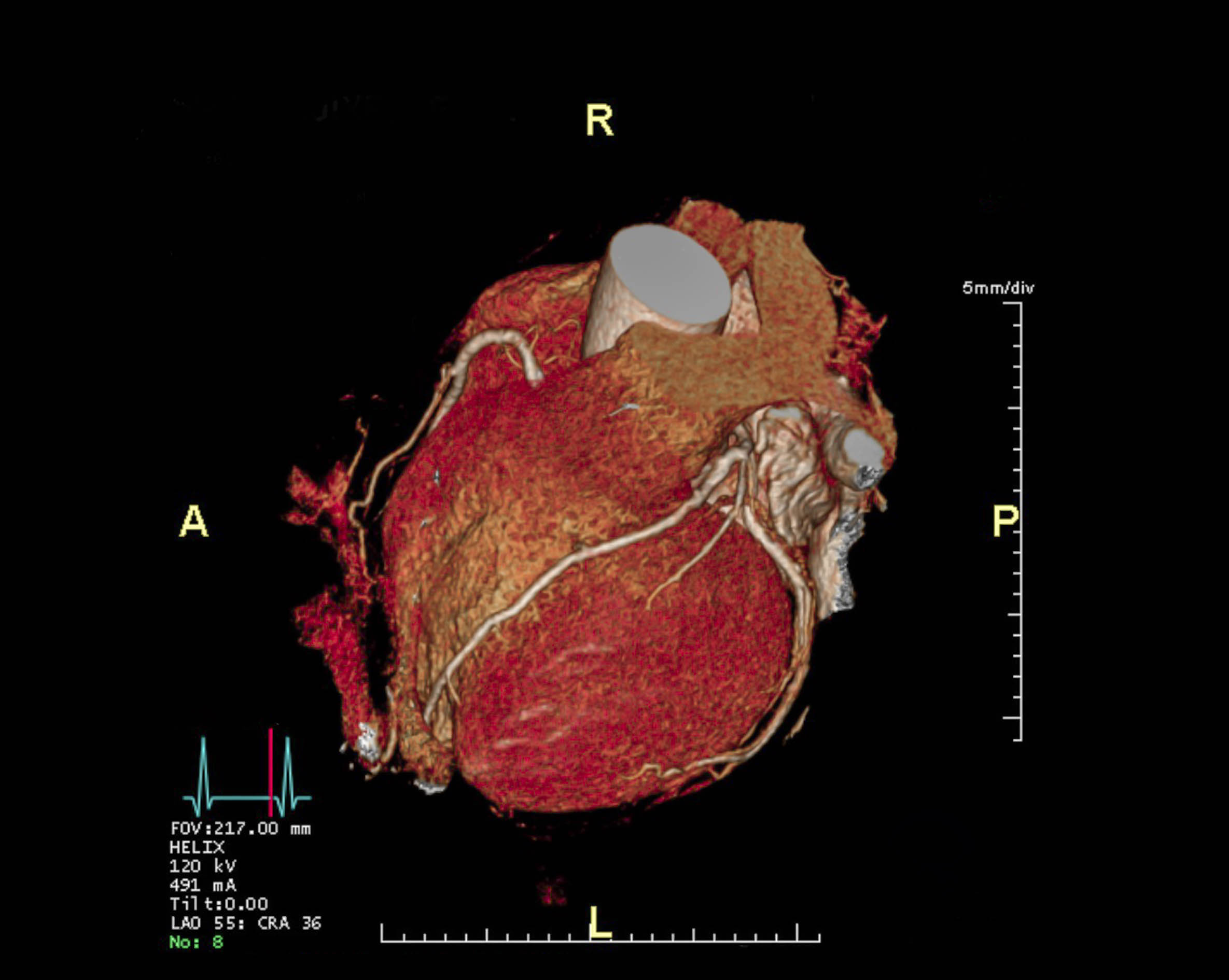 3D medical scan of a human heart from a coronary CT angiogram, with labeled anatomical directions (anterior, posterior, right, left); includes a color-coded heartbeat graph and measurement scale on a black background.
